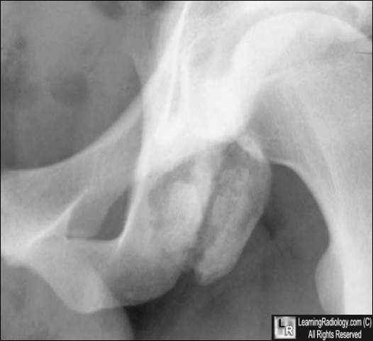 Ischial avulsion